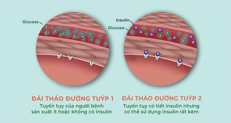 Bản chất của bệnh là do tuyến tụy bị tổn thương, thuốc Tây điều trị triệu chứng bệnh nhưng lại làm tổn thương thêm tuyến tụy! Sao lại như thế? 4